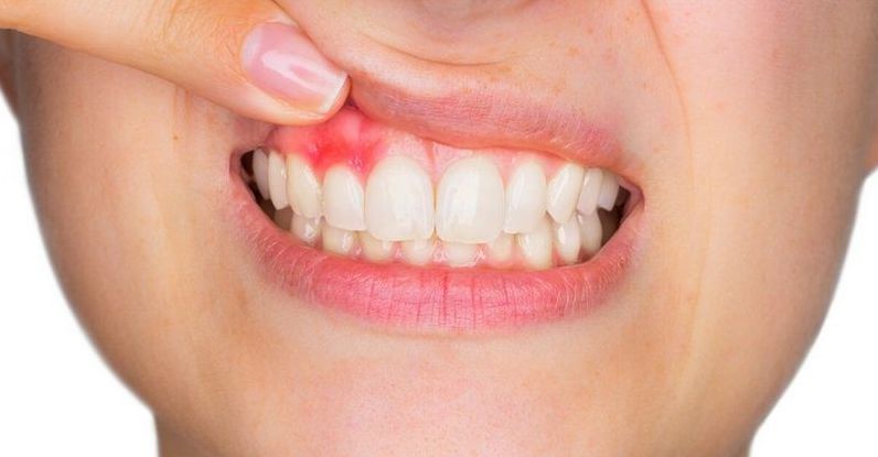Зубные кисты: понимание лечения и удаления